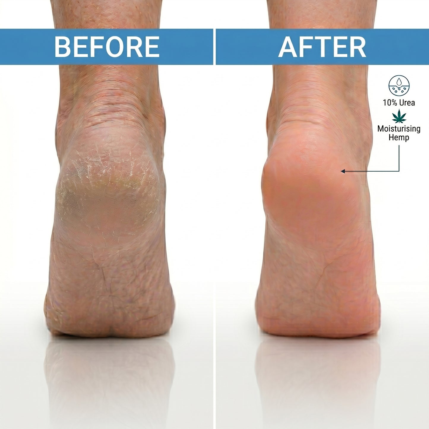 Urea Cream 10% with Hemp oil, for Very Dry Skin & Cracked Heels, Deep Moisturising Foot & Body Cream - 3 x 100 ml