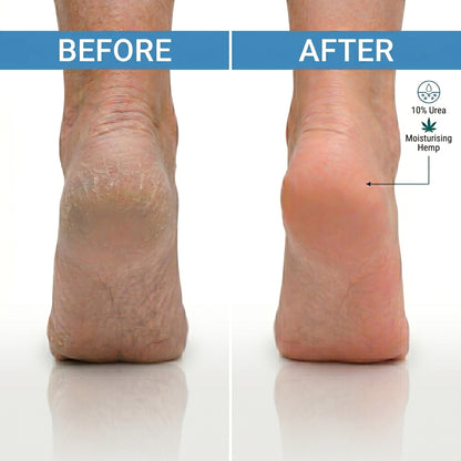 Urea Cream 10% with Hemp oil, for Very Dry Skin & Cracked Heels, Deep Moisturising Foot & Body Cream - 3 x 100 ml