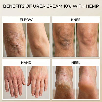 Urea Cream 10% with Hemp oil, for Very Dry Skin & Cracked Heels, Deep Moisturising Foot & Body Cream - 3 x 100 ml